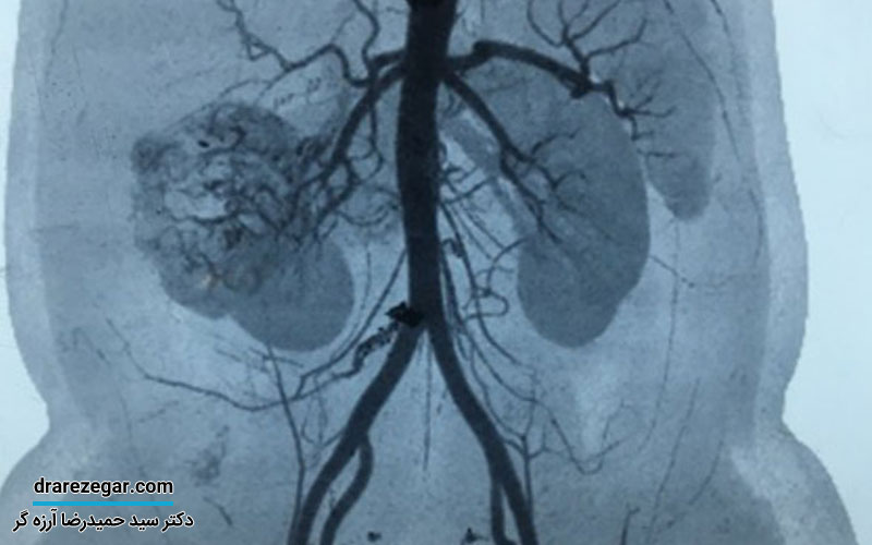 لخته شدن خون در وریدهای کلیوی