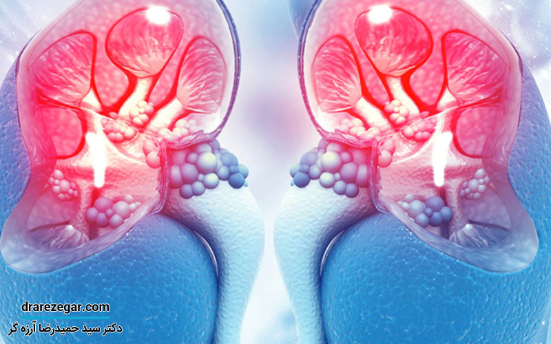 لخته شدن خون در وریدهای کلیوی