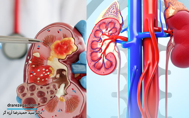 علائم گوارشی سنگ کلیه