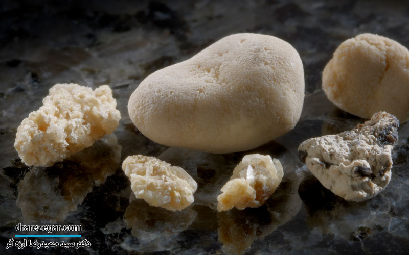 چند روز طول می کشد سنگ کلیه دفع شود