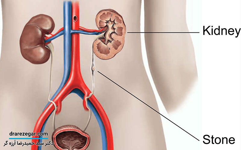 چند روز طول می کشد سنگ کلیه دفع شود