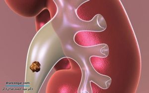 چند روز طول می کشد سنگ کلیه دفع شود