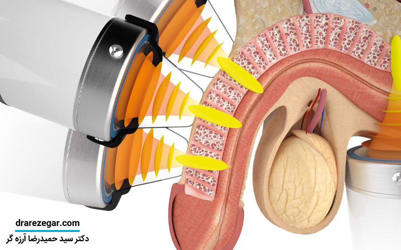 شاک ویوتراپی برای نعوظ