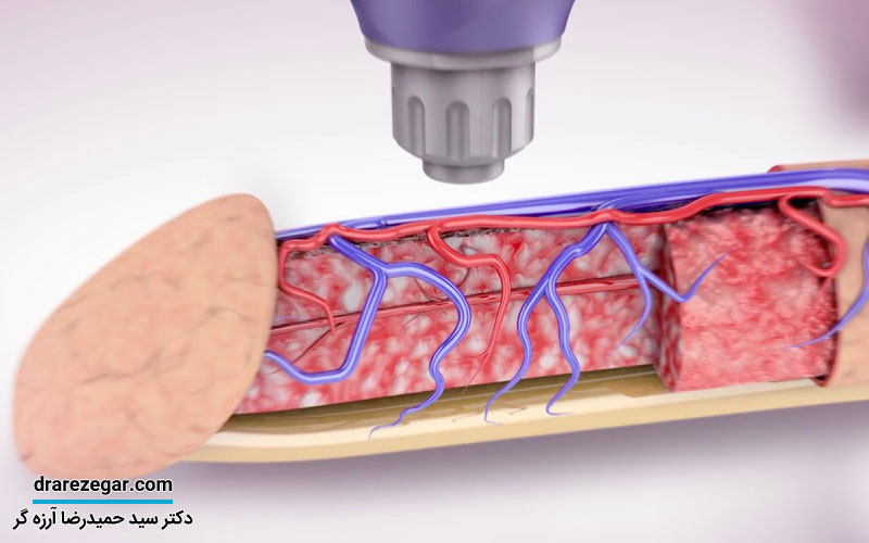 شاک ویوتراپی برای نعوظ