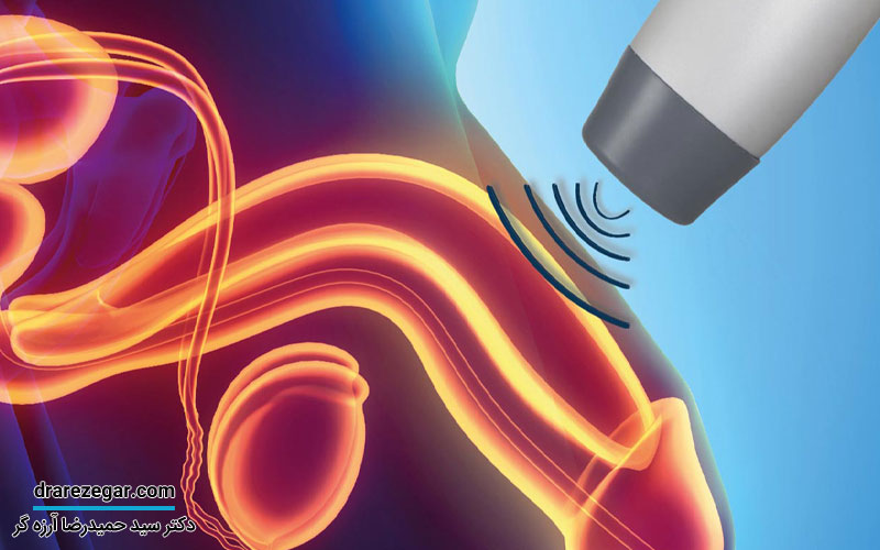 شاک ویوتراپی برای نعوظ