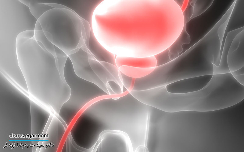 درمان دیورتیکول مجرای ادرار