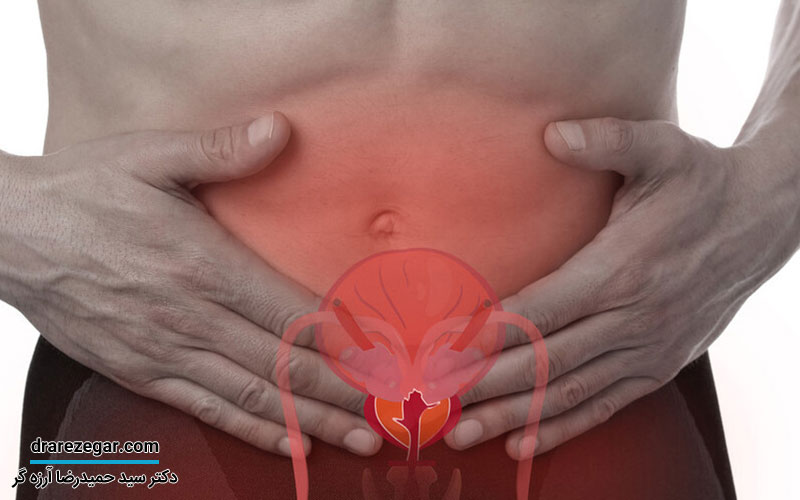 درمان دیورتیکول مجرای ادرار