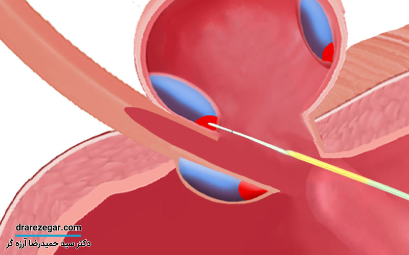 درمان دیورتیکول مجرای ادرار
