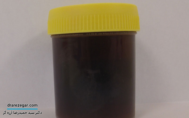 ادرار سیاه چیست