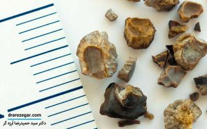 آیا کلیه سنگ ساز درمان دارد