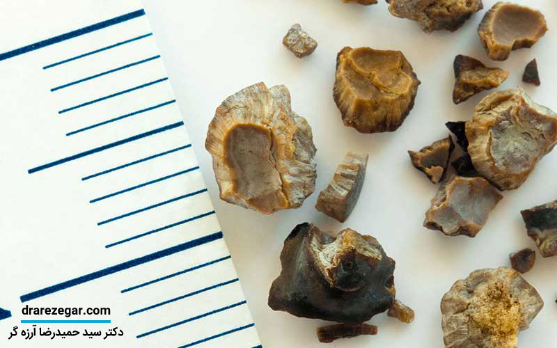 آیا کلیه سنگ ساز درمان دارد