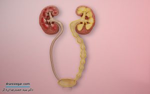 ریفلاکس مثانه به حالب چیست