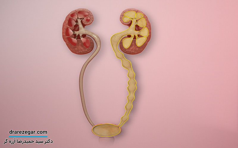 ریفلاکس مثانه به حالب چیست